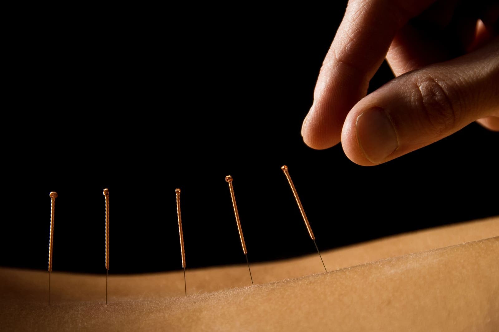 Acupuntura